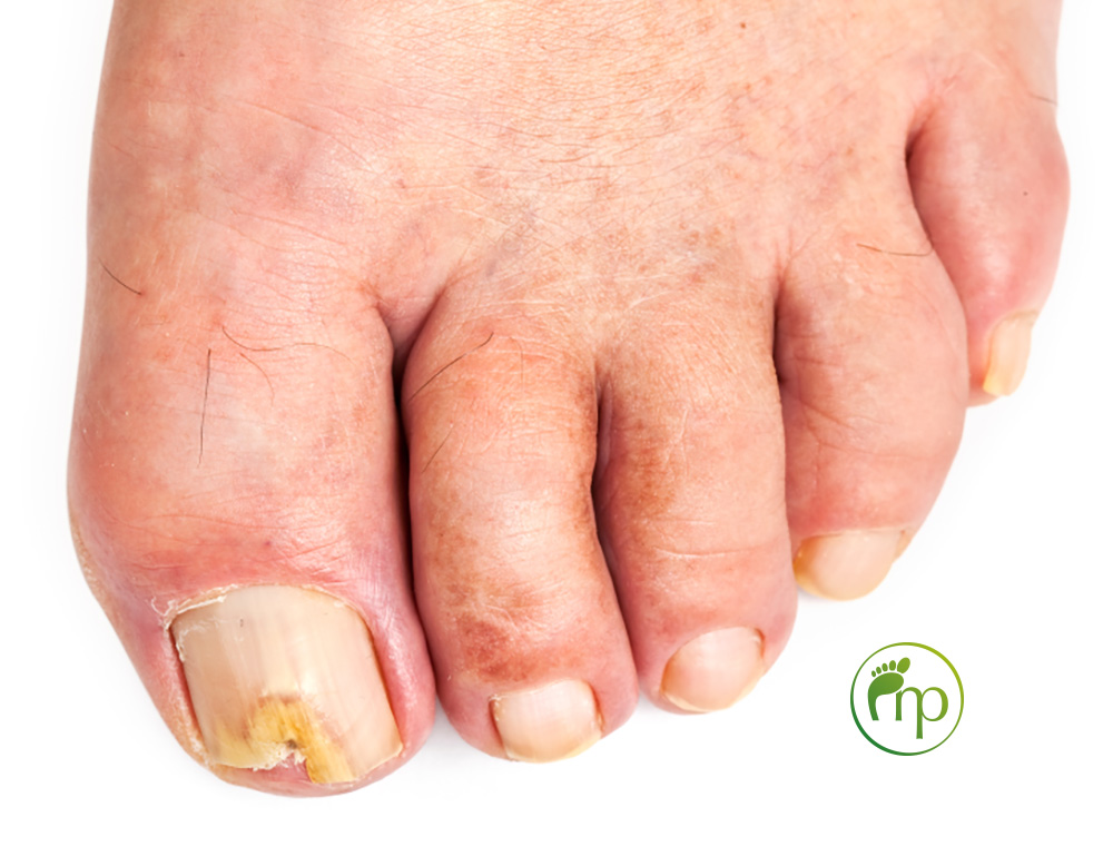 Schimmelnagel, Medisch Pedicure in Hilversum